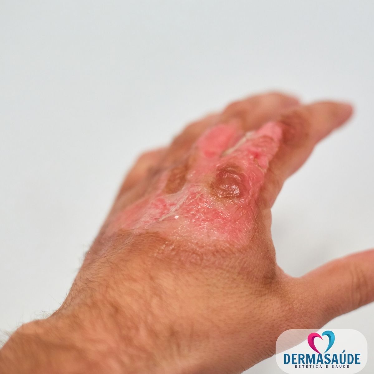 Kit Cicatrizante Calmante Tatoo Seca Espinhas Queimaduras