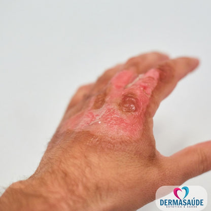 Kit Cicatrizante Calmante Tatoo Seca Espinhas Queimaduras