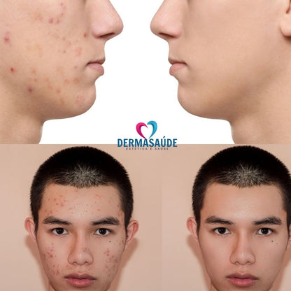 Kit Facial Para Pele Oleosa Acne Espinha e Cravos Tulipia