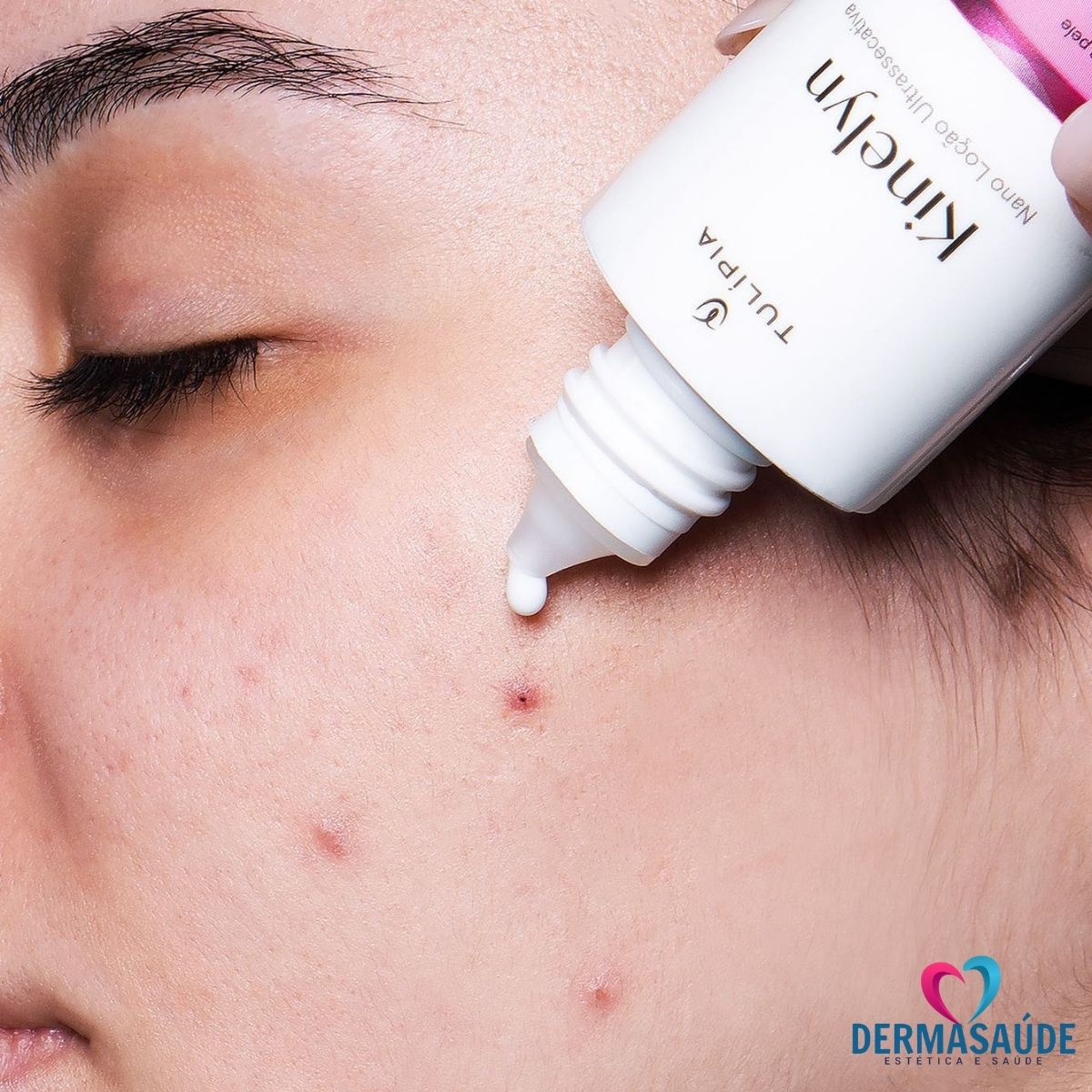 Kit Facial Para Pele Oleosa Acne Espinha e Cravos Tulipia