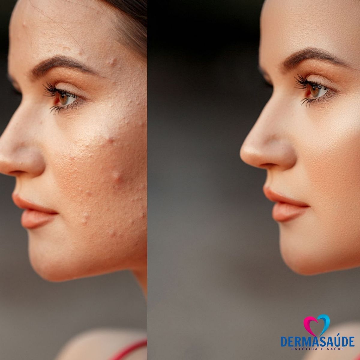 Kit Facial Para Pele Oleosa Acne Espinha e Cravos Tulipia