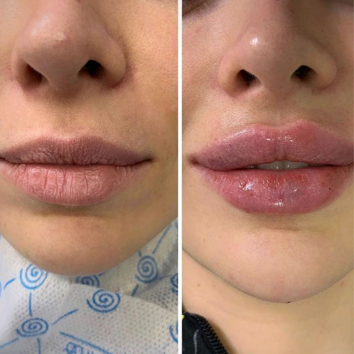 Kit Labial Hidragloss Espuma Esfoliante Gloss Tulípia Cereja